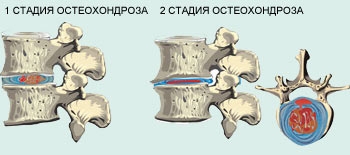 1 и 2 стадии остеохондроза