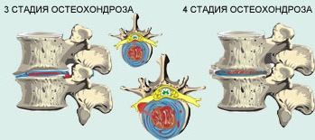 3 и 4 стадии остеохондроза